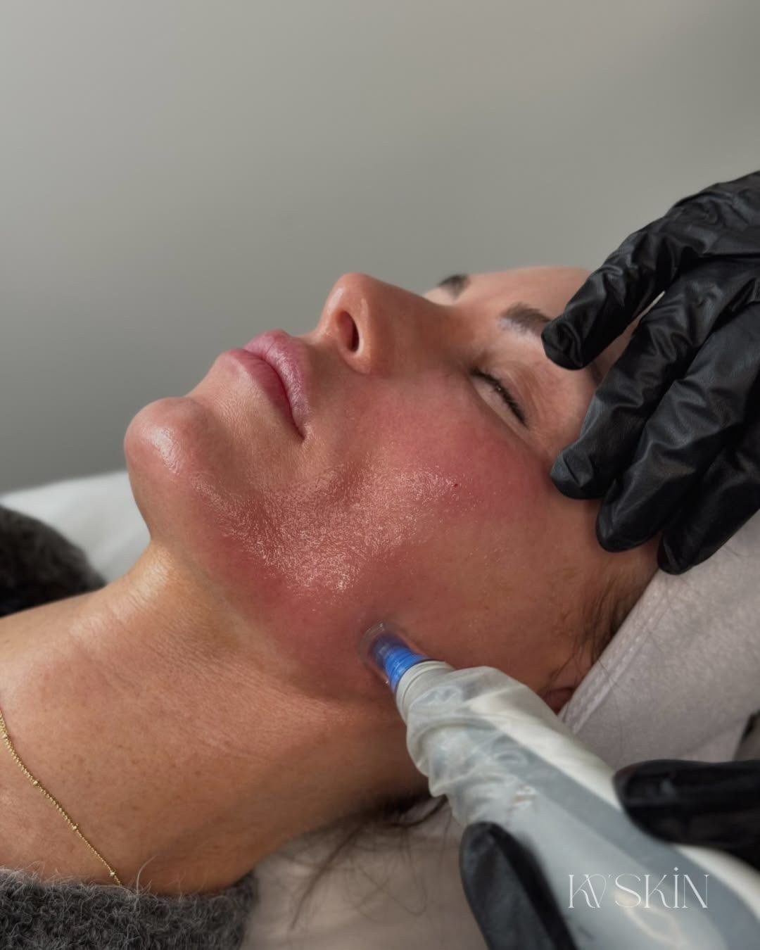 Microneedling